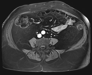 Adrenal cortical carcinoma (Radiopaedia 64017-72770 J 69).jpg