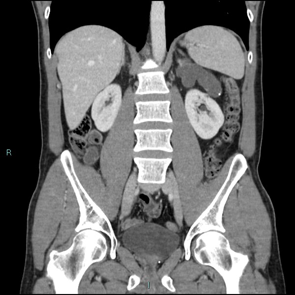 Adrenal cystic lymphangioma (Radiopaedia 83161-97534 Coronal C+ portal venous phase 44).jpg