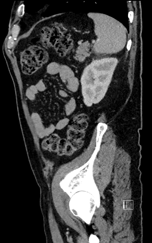 Adrenal lymphoma (Radiopaedia 73730-84529 Sagittal C+ portal venous phase 87).jpg
