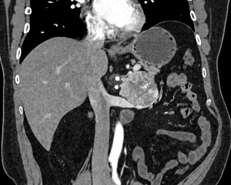 Adrenal metastases (Radiopaedia 73082-83791 Coronal C+ arterial phase 18).jpg