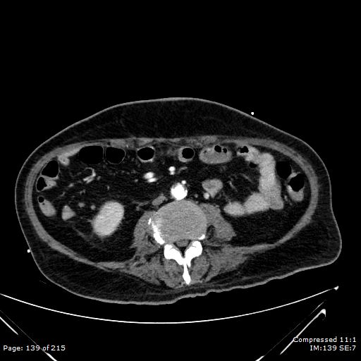 Adrenal metastasis (Radiopaedia 78425-91079 Axial C+ arterial phase 69).jpg