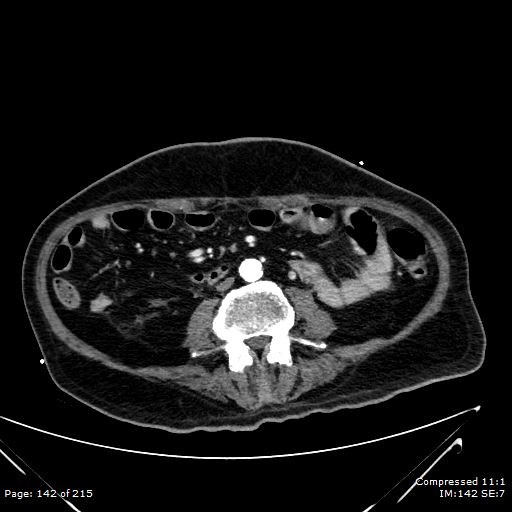 Adrenal metastasis (Radiopaedia 78425-91079 Axial C+ arterial phase 72).jpg
