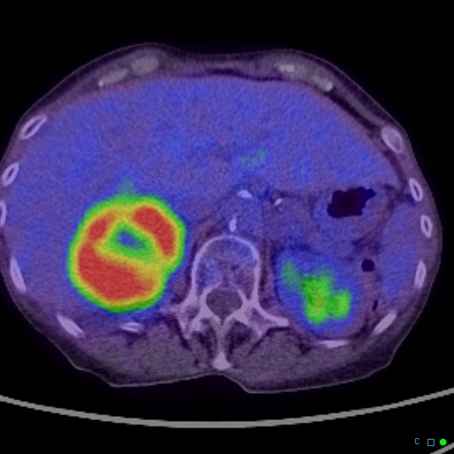File:Adrenal metastasis from small cell lung cancer (Radiopaedia 19133-19109 B 1).jpg