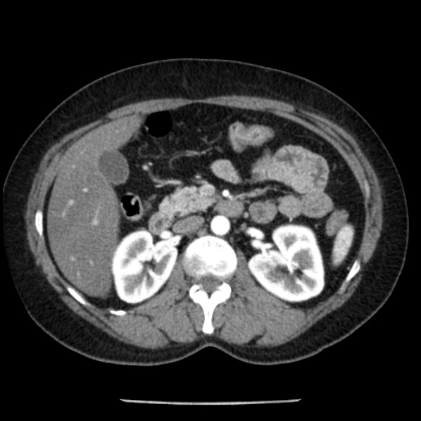 Adrenal myelolipoma (Radiopaedia 43401-46759 Axial C+ arterial phase 40).jpg