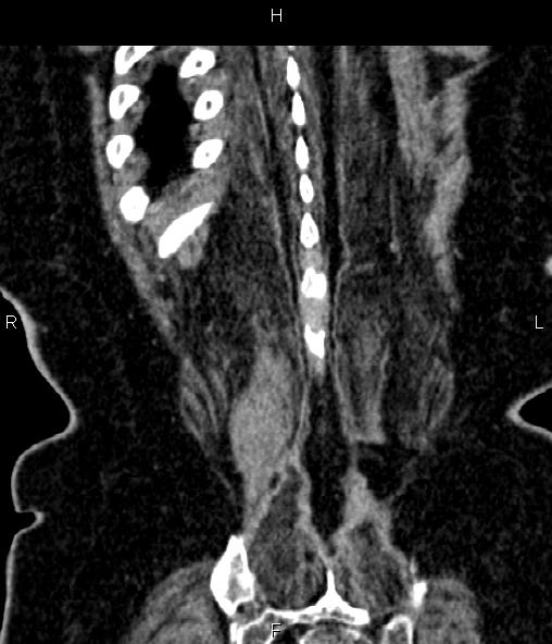 Adrenal myelolipoma (Radiopaedia 82742-96986 Coronal renal cortical phase 70).jpg