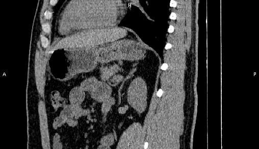 Adrenal myelolipoma (Radiopaedia 84321-99619 Sagittal non-contrast 70).jpg