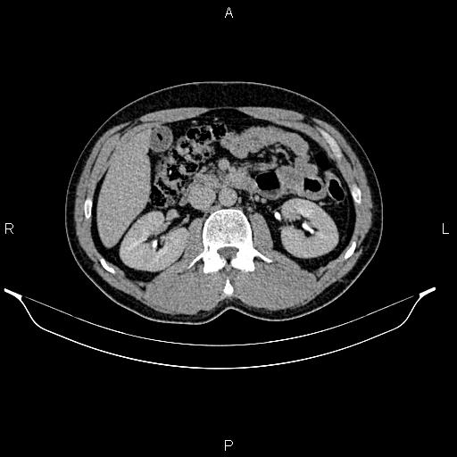 Adrenal myelolipoma (Radiopaedia 87794-104246 Axial renal excretory phase 42).jpg