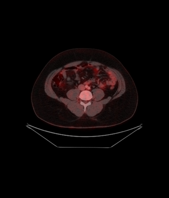 Adrenocortical carcinoma (Radiopaedia 80134-93440 ِAxial 202).jpg