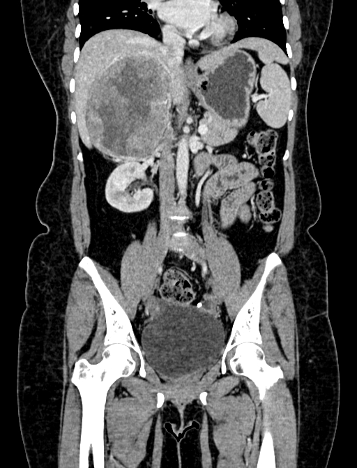Adrenocortical carcinoma (Radiopaedia 87281-103569 Coronal C+ portal venous phase 50).jpg