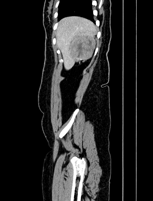 Adrenocortical carcinoma (Radiopaedia 87281-103569 Sagittal C+ portal venous phase 21).jpg