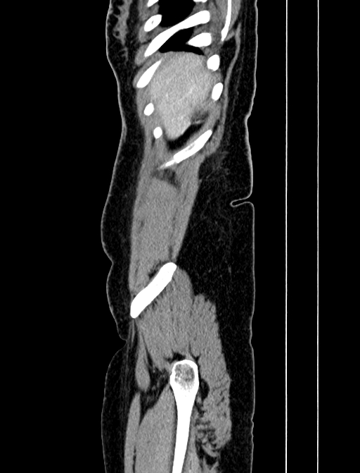 Adrenocortical carcinoma (Radiopaedia 87281-103569 Sagittal C+ portal venous phase 6).jpg