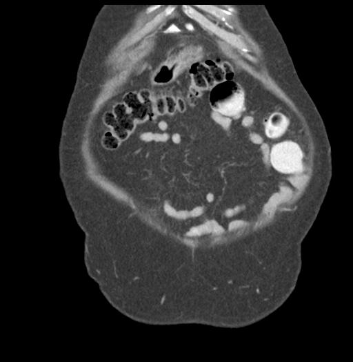 Adult ileal intussusception with secondary obstruction (Radiopaedia 30395-31051 Coronal C+ portal venous phase 11).jpg