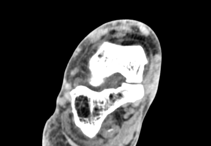 Advanced osteomyelitis due to open metatarsal fracture (Radiopaedia 83891-99095 Axial non-contrast 10).jpg