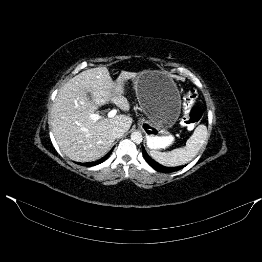 Afferent loop syndrome - secondary to incarcerated trocar site hernia (Radiopaedia 82959-97305 Axial C+ portal venous phase 56).jpg