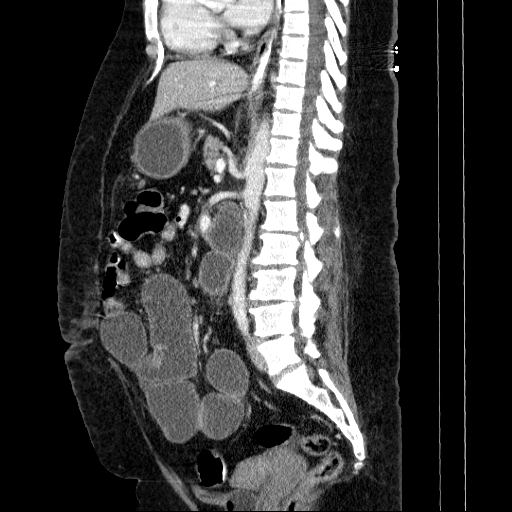Afferent loop syndrome - secondary to incarcerated trocar site hernia (Radiopaedia 82959-97305 Sagittal C+ portal venous phase 74).jpg