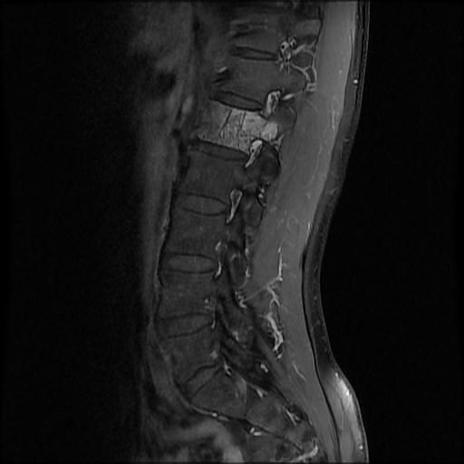 File:Aggressive vertebral hemangioma with pathological fracture (Radiopaedia 69528-79411 F 2).jpg