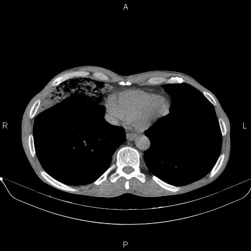 Air bronchogram in pneumonia (Radiopaedia 85719-101512 Axial non-contrast 51).jpg