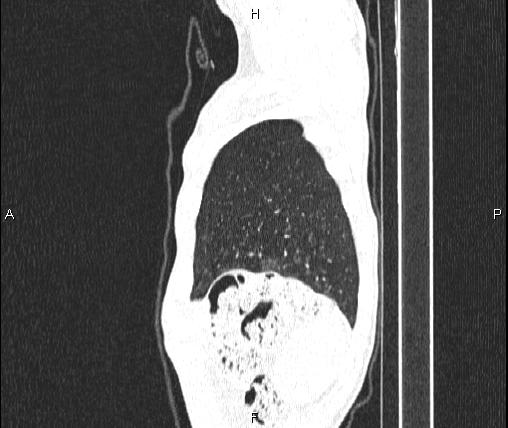 File:Air bronchogram in pneumonia (Radiopaedia 85719-101512 Sagittal lung window 93).jpg