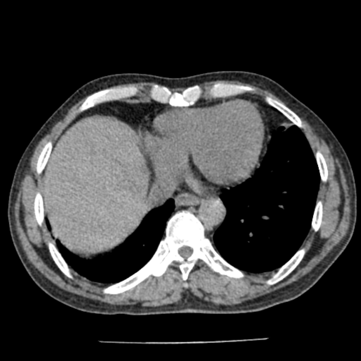 Airway foreign body in adult (Radiopaedia 85907-101779 Axial liver window 142).jpg