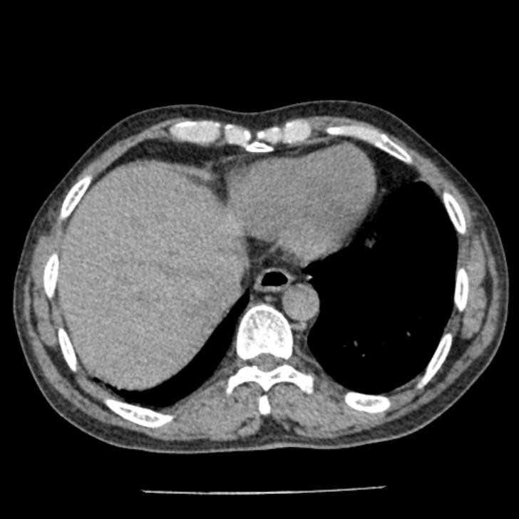 Airway foreign body in adult (Radiopaedia 85907-101779 Axial liver window 153).jpg