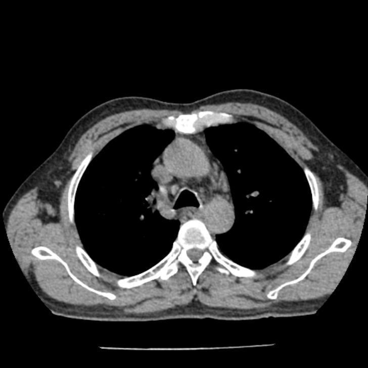 Airway foreign body in adult (Radiopaedia 85907-101779 Axial liver window 47).jpg
