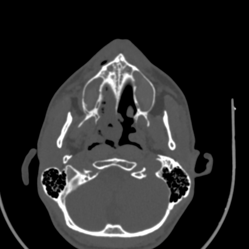 Allergic fungal sinusitis (Radiopaedia 88725-105456 Axial bone window 7).jpg