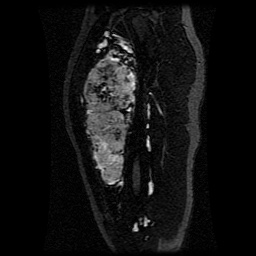 Alveolar soft part sarcoma (Radiopaedia 64501-73678 D 83).jpg