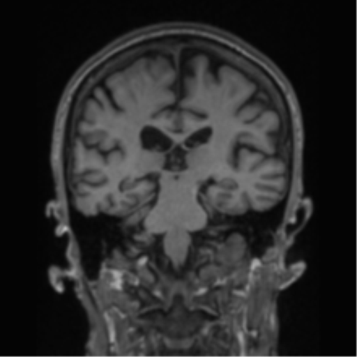 File:Alzheimer's disease- with apraxia (Radiopaedia 54763-61011 Coronal T1 43).png