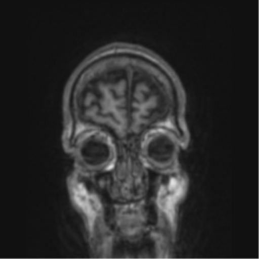 File:Alzheimer's disease- with apraxia (Radiopaedia 54763-61011 Coronal T1 85).png