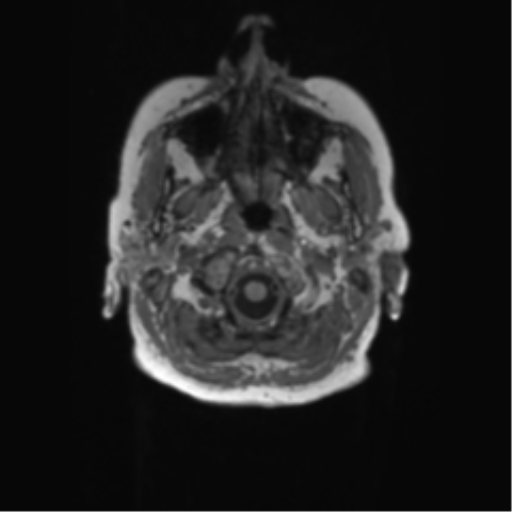 File:Alzheimer's disease (Radiopaedia 42658-45802 Axial T1 144).png