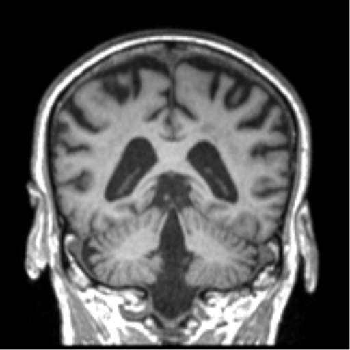 Alzheimer disease and cerebral amyloid angiopathy (Radiopaedia 64234-73011 Coronal T1 20).png