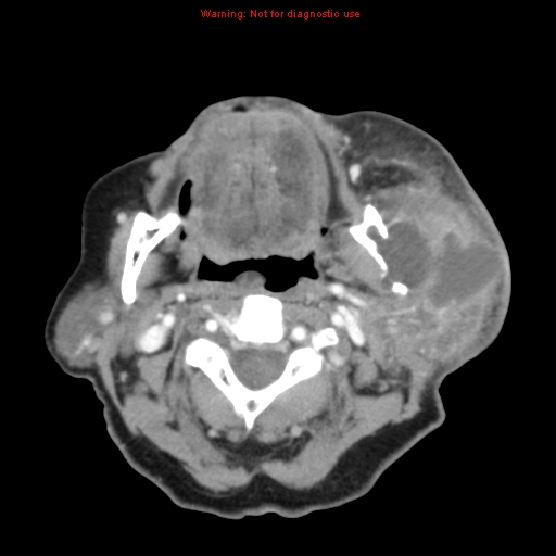 Ameloblastoma (Radiopaedia 27437-27631 A 38).jpg