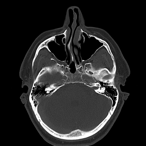 File:Ameloblastoma (Radiopaedia 38520-40623 Axial bone window 11).png