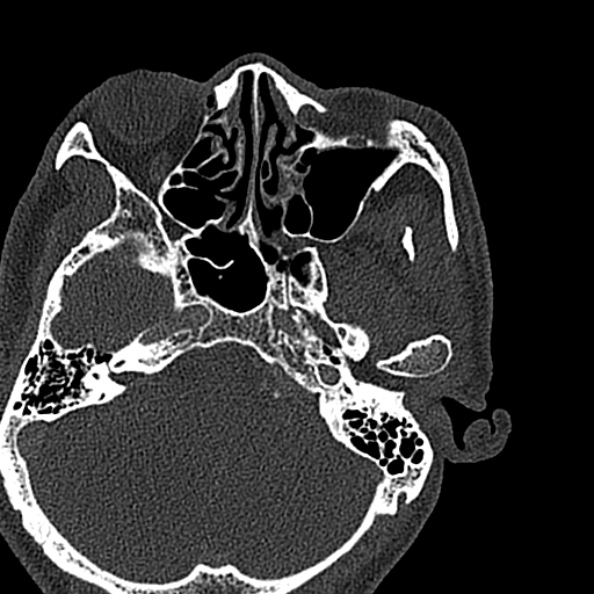 Ameloblastoma (Radiopaedia 51921-57766 Axial bone window 154).jpg