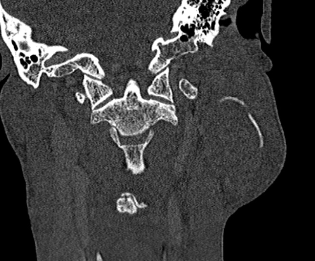 Ameloblastoma (Radiopaedia 51921-57766 Coronal bone window 225).jpg