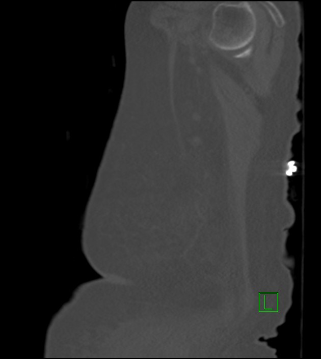 Amiodarone deposition in the liver (Radiopaedia 77587-89780 Sagittal bone window 10).jpg