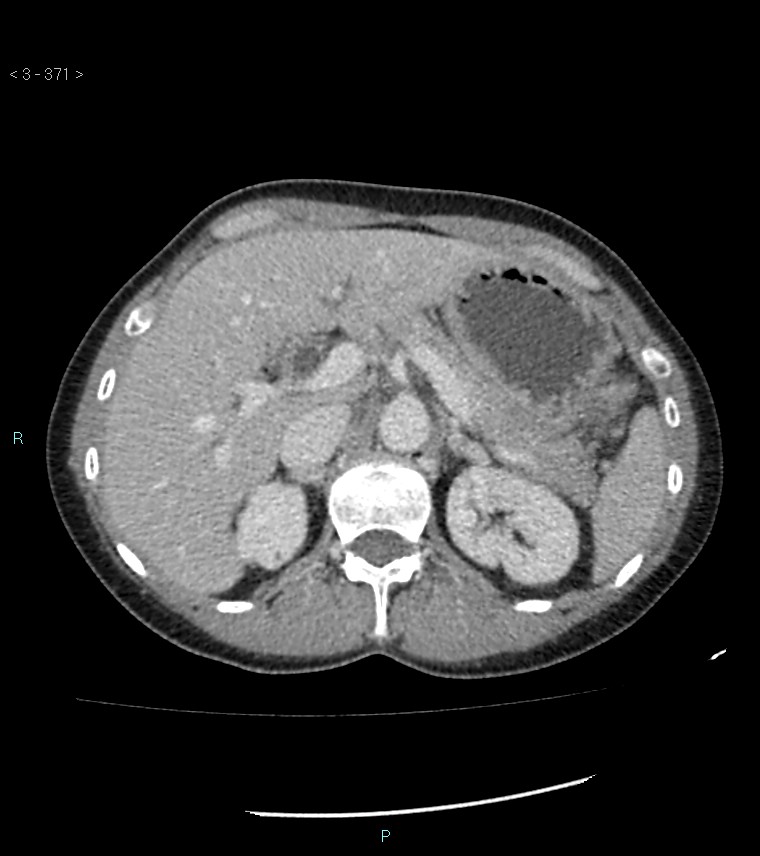 Ampulla of Vater metastasis (Radiopaedia 27820-28069 A 9).jpg