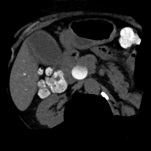 Ampullary adenocarcinoma (Radiopaedia 34013-35241 AXIAL MIPS 3-1.5 60).png