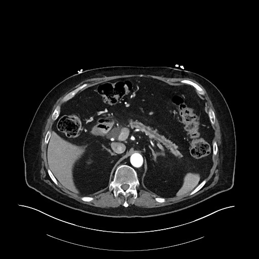 Ampullary adenocarcinoma (Radiopaedia 59373-66734 A 53).jpg