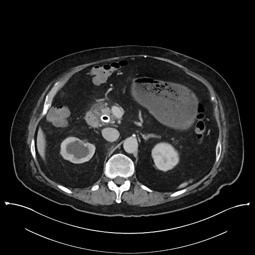 Ampullary adenocarcinoma (Radiopaedia 59373-66737 A 60).jpg