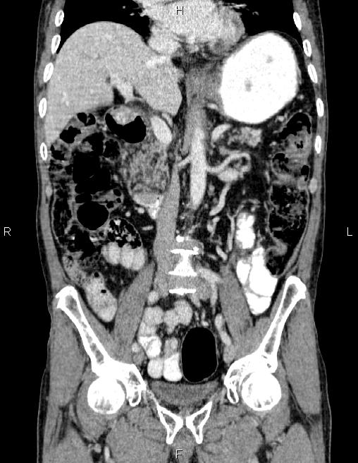 Ampullary adenocarcinoma (Radiopaedia 86093-102032 C 33).jpg