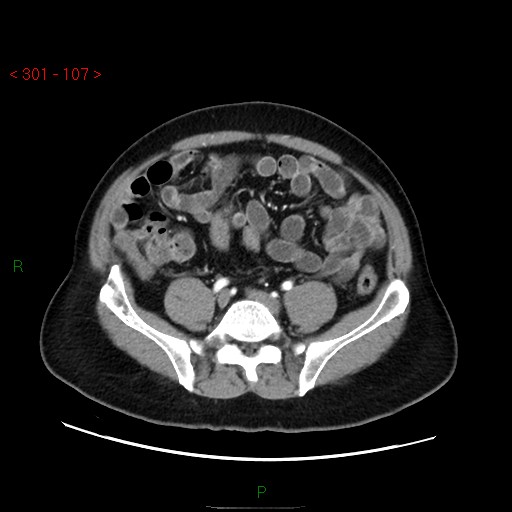 Ampullary carcinoma (Radiopaedia 56396-63056 B 53).jpg