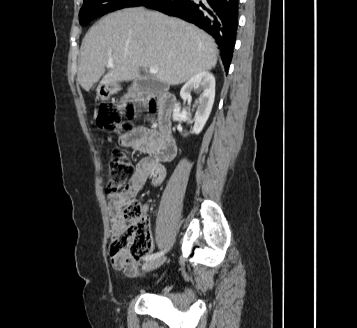 File:Ampullary tumor (Radiopaedia 60333-67998 C 18).jpg