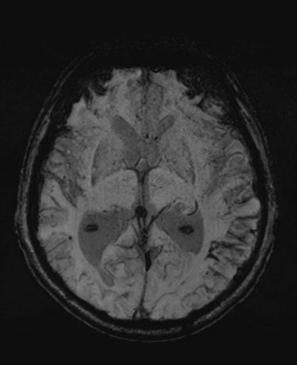 File:Amyloid angiopathy with inflammation (Radiopaedia 30360-31002 Axial SWI MIP 26).jpg
