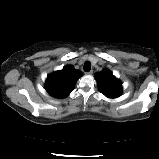 Amyloidosis - bronchial and diffuse nodular pulmonary involvement (Radiopaedia 60156-67744 Axial non-contrast 8).jpg