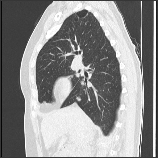 Amyloidosis - bronchial and diffuse nodular pulmonary involvement (Radiopaedia 60156-67744 F 22).jpg