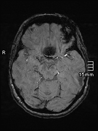 Amyotrophic lateral sclerosis (Radiopaedia 70821-81017 Axial SWI 18).jpg