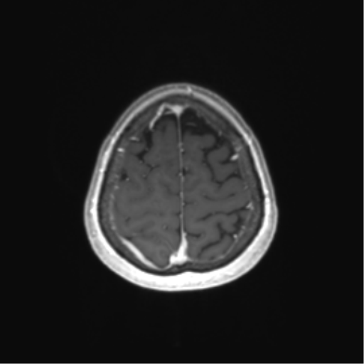 File:Anaplastic astrocytoma (Radiopaedia 86943-103160 Axial T1 C+ 77).png