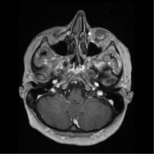 File:Anaplastic astrocytoma IDH wild-type (pseudoprogression) (Radiopaedia 42209-45276 Axial T1 C+ 35).png