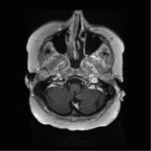 File:Anaplastic astrocytoma IDH wild-type (pseudoprogression) (Radiopaedia 42209-45279 Axial T1 C+ 22).png